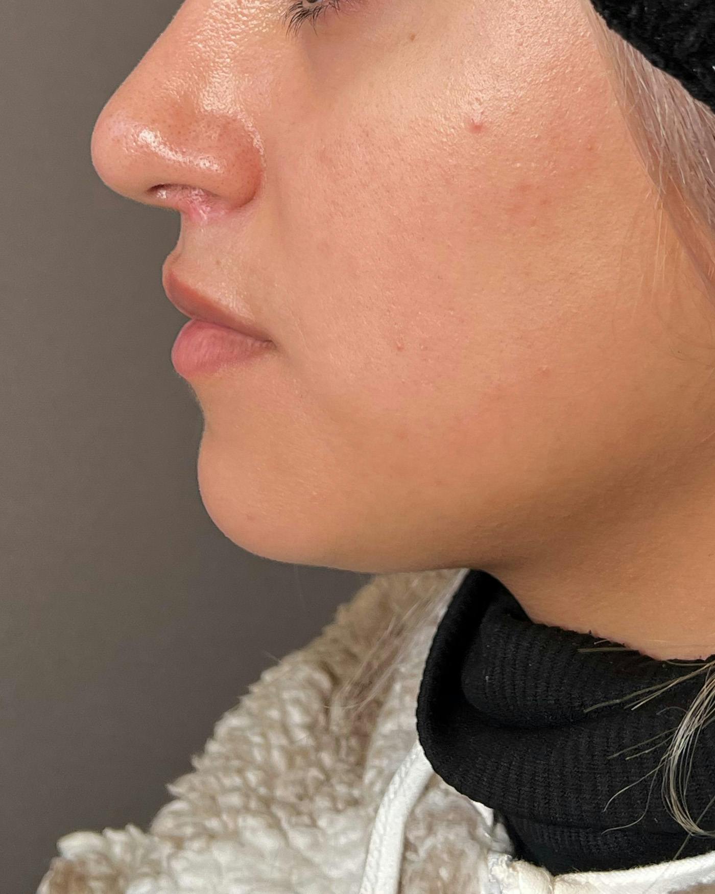 Lip Lift / Lip Reduction Before & After Gallery - Patient 310400 - Image 8