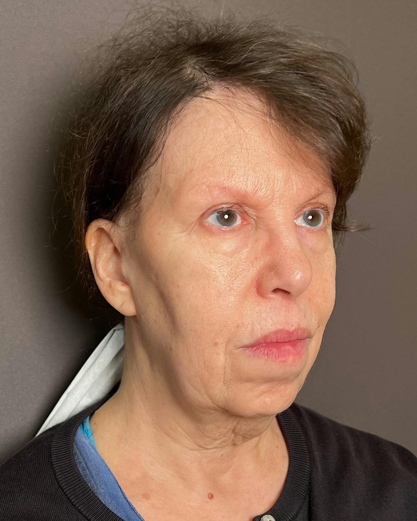 Facelifts / Necklift Before & After Gallery - Patient 183402 - Image 3