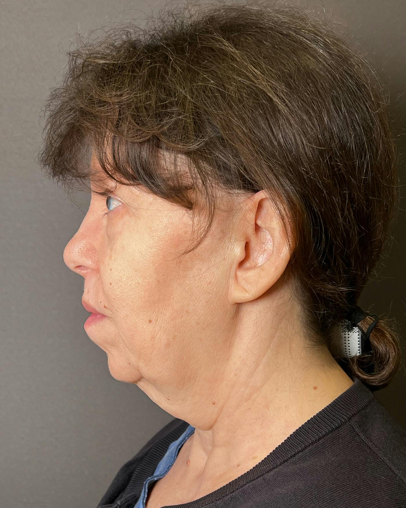 Facelifts / Necklift Before & After Gallery - Patient 183402 - Image 7