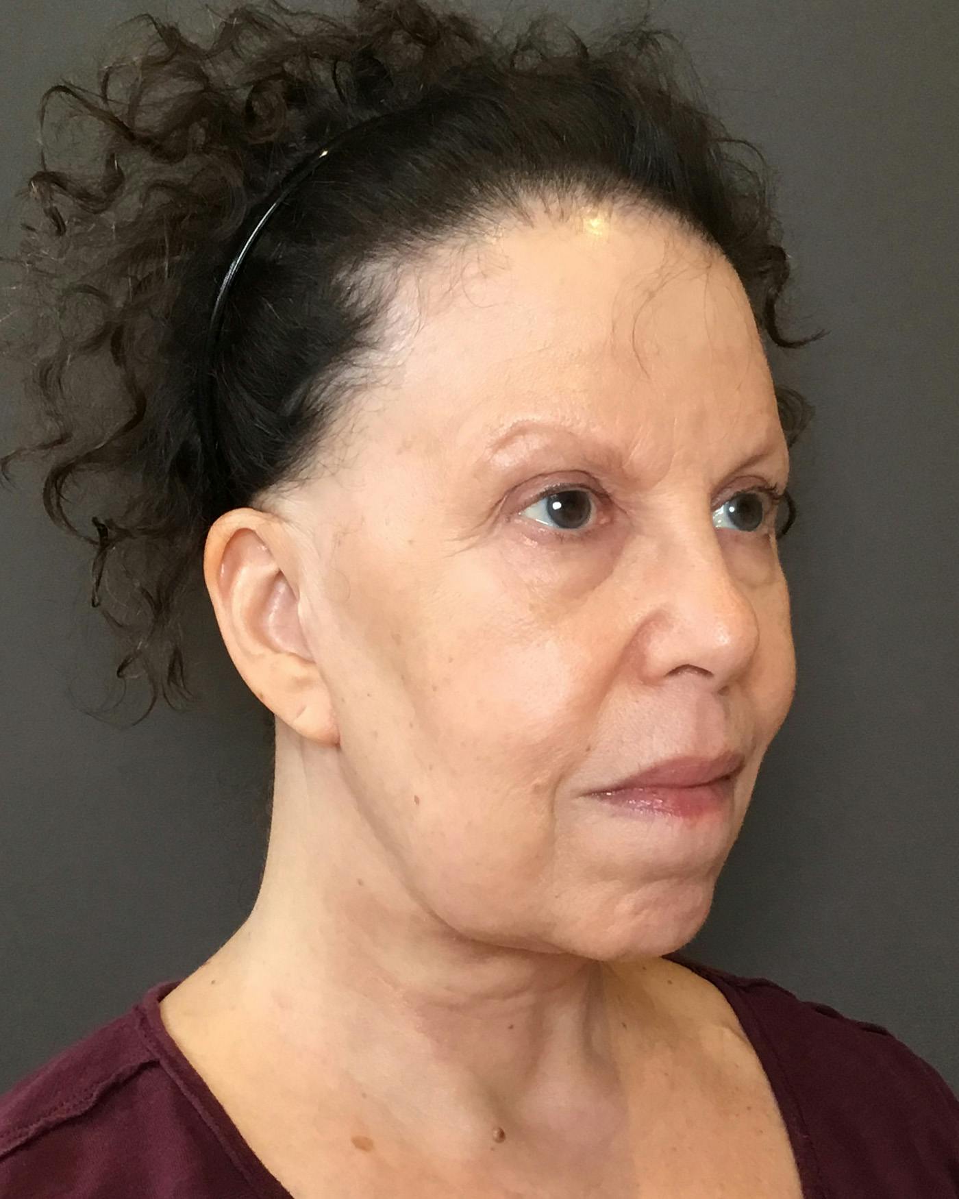 Facelifts / Necklift Before & After Gallery - Patient 183402 - Image 4