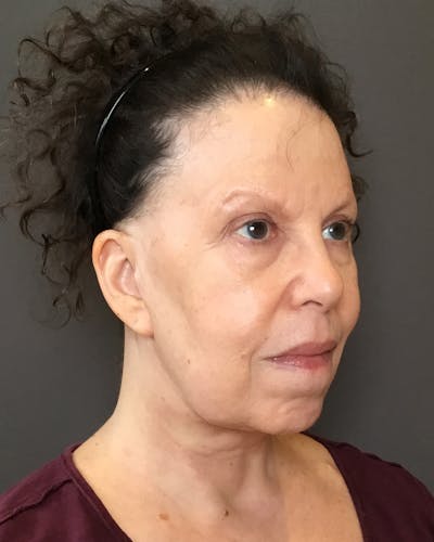 Facelifts / Necklift Before & After Gallery - Patient 183402 - Image 2