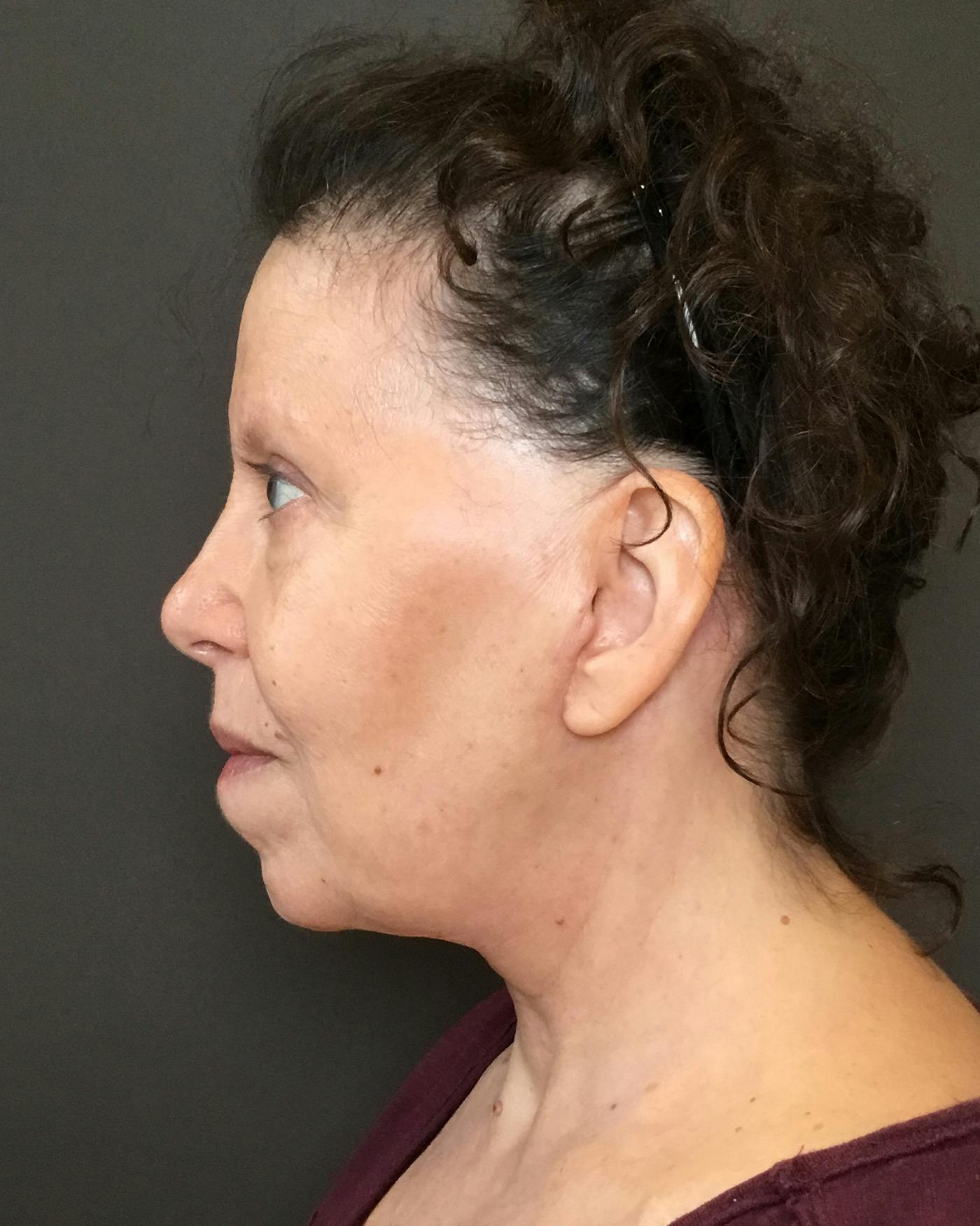 Facelifts / Necklift Before & After Gallery - Patient 183402 - Image 8