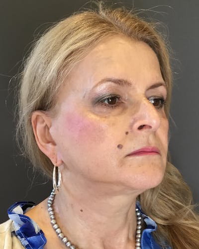 Facelifts / Necklift Before & After Gallery - Patient 737281 - Image 2
