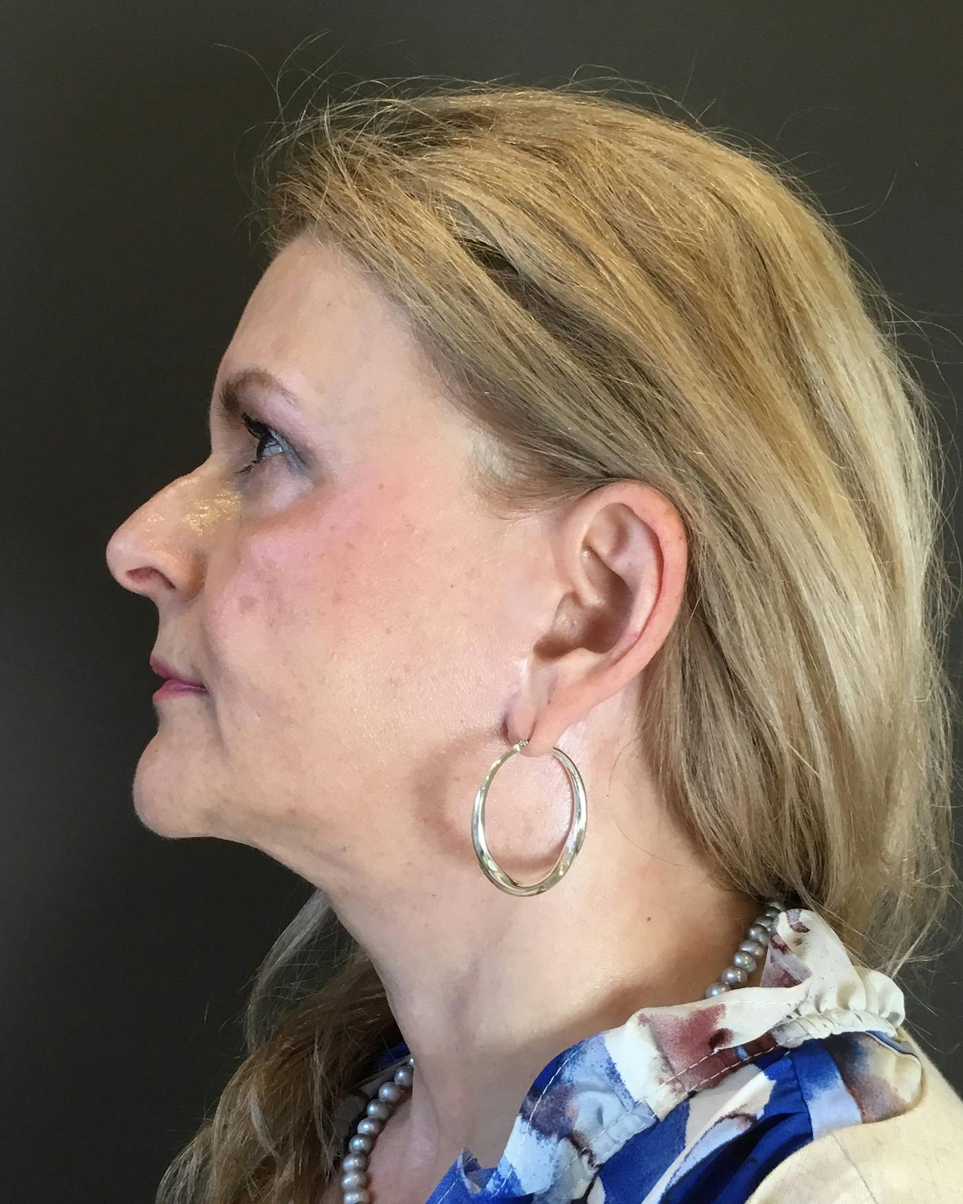 Facelifts / Necklift Before & After Gallery - Patient 737281 - Image 8