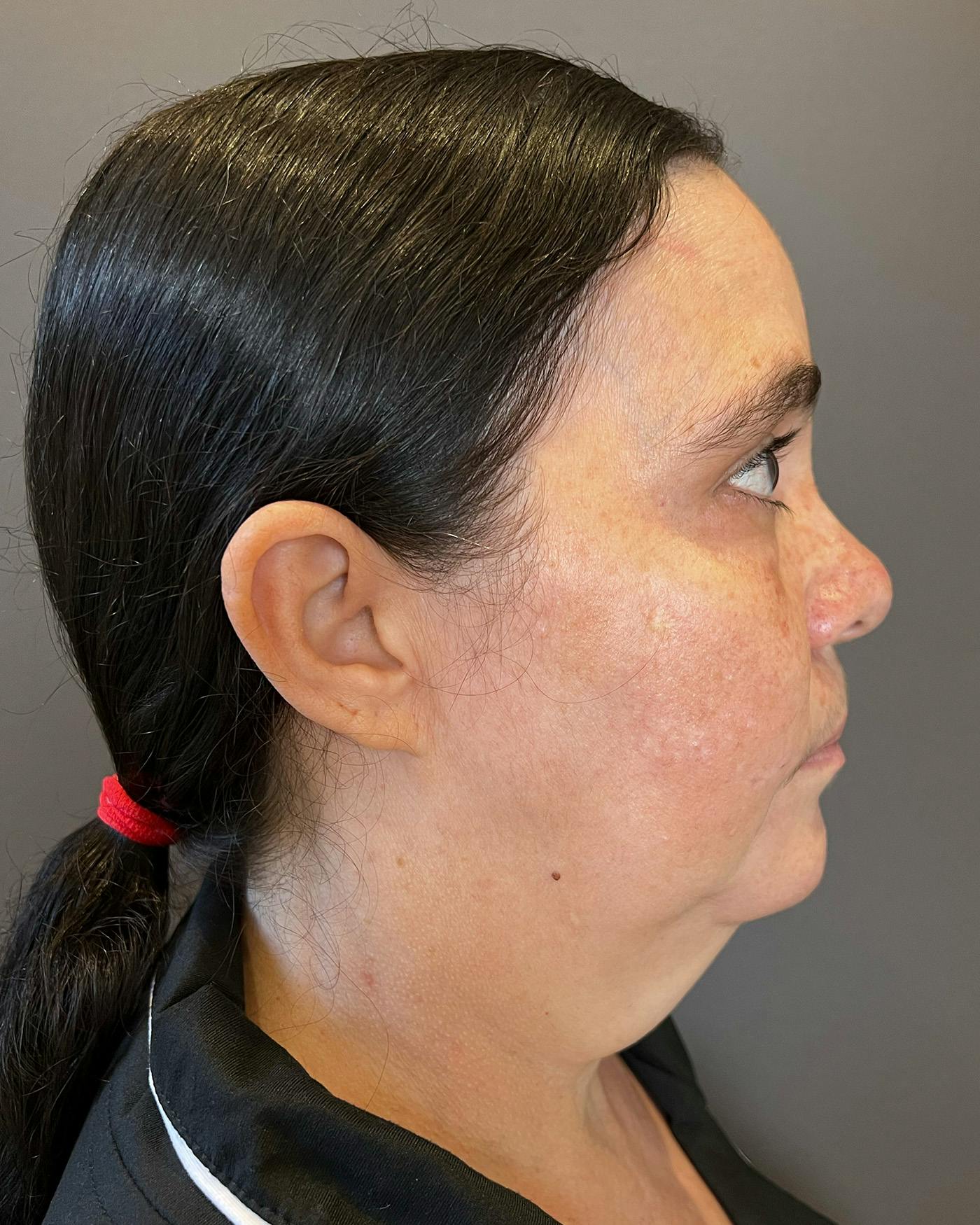 Facelifts / Necklift Before & After Gallery - Patient 754198 - Image 1