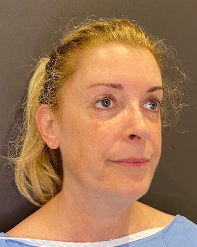 Facelifts / Necklift Before & After Gallery - Patient 830010 - Image 1