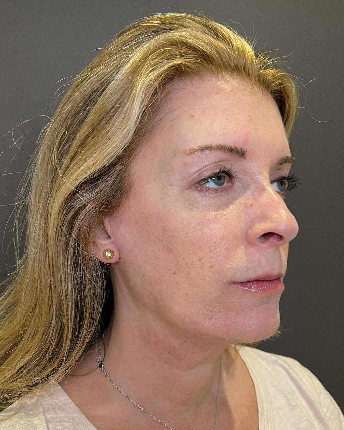 Facelifts / Necklift Before & After Gallery - Patient 830010 - Image 4