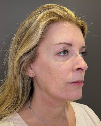 Facelifts / Necklift Before & After Gallery - Patient 830010 - Image 2