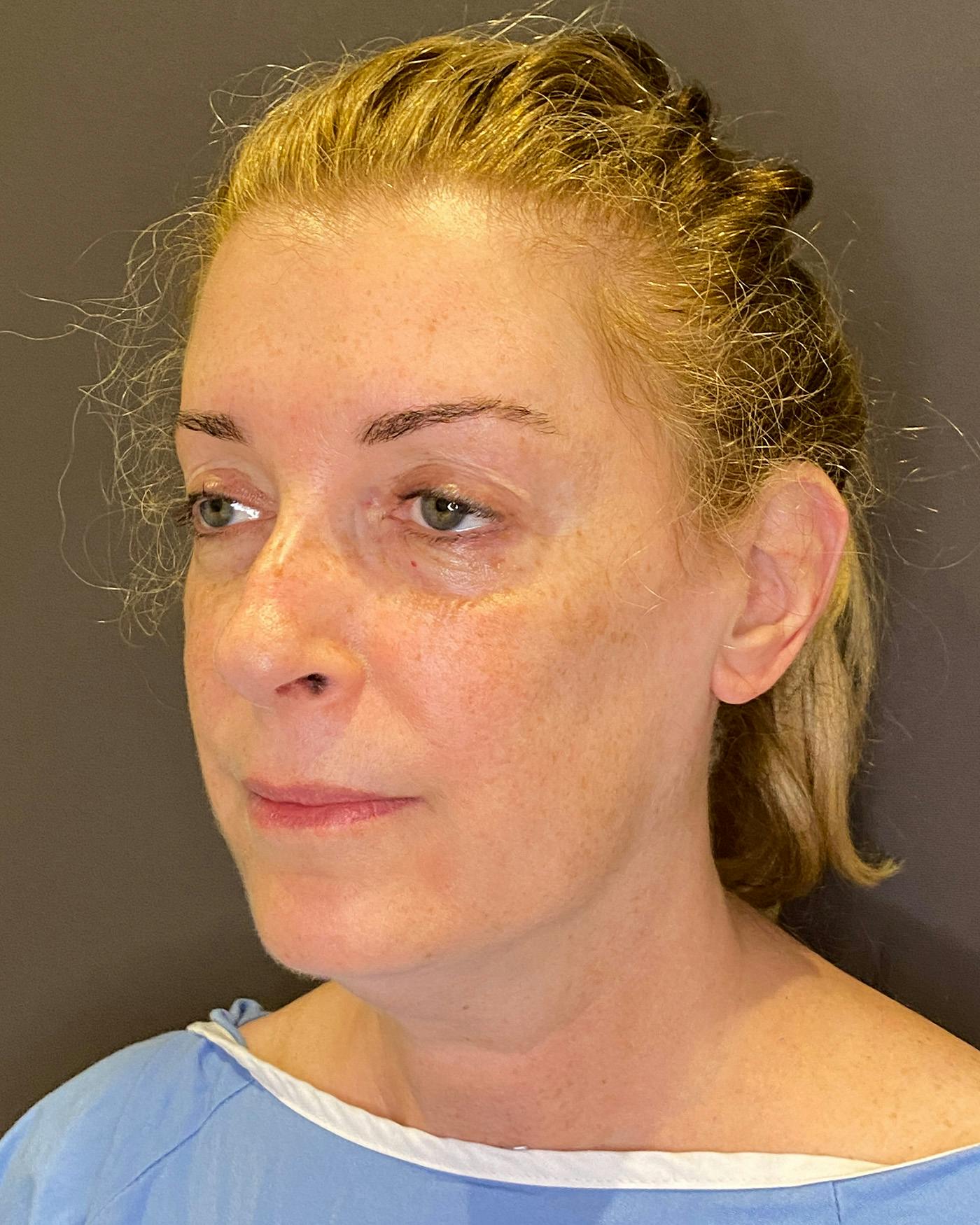 Facelifts / Necklift Before & After Gallery - Patient 830010 - Image 7