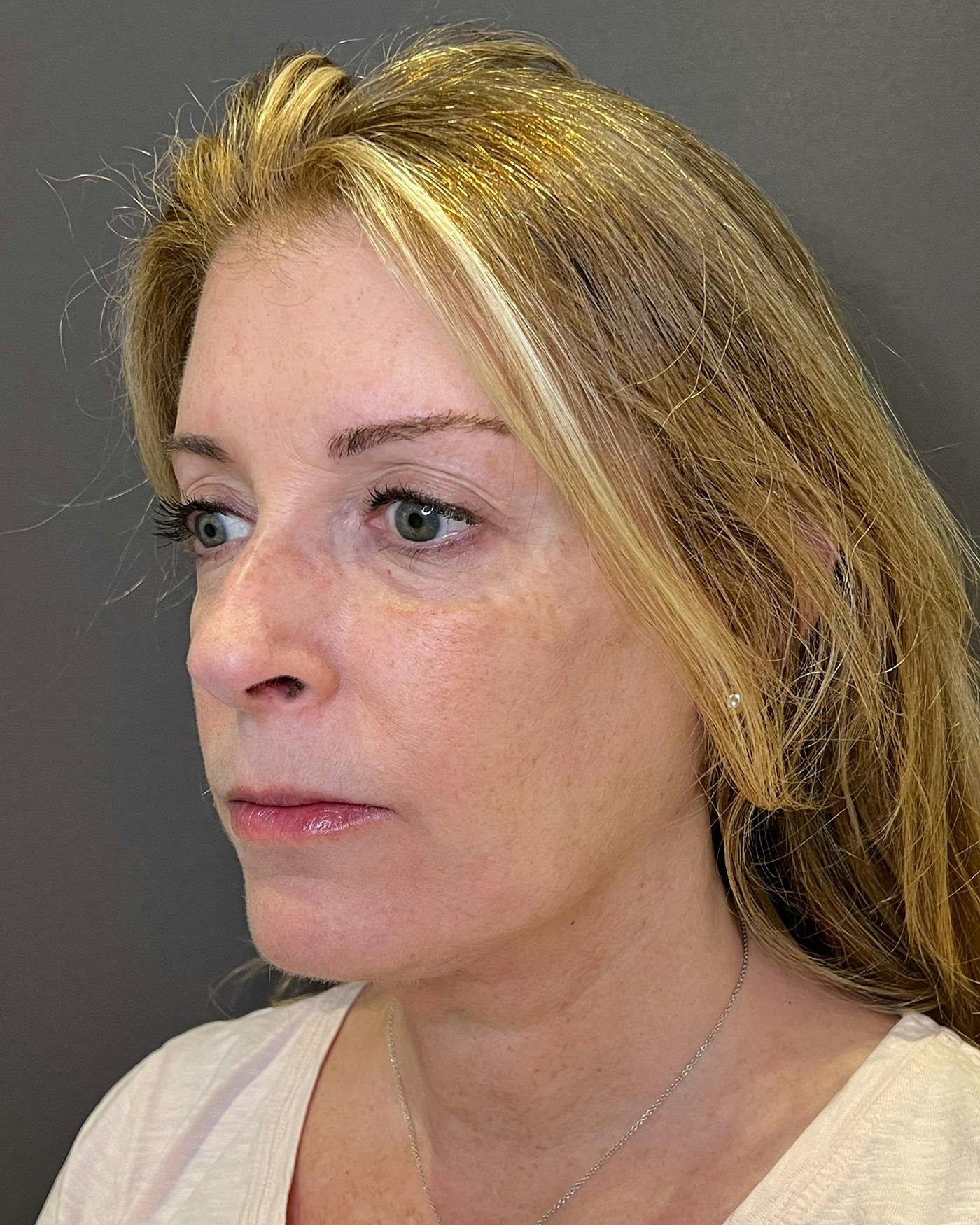 Facelifts / Necklift Before & After Gallery - Patient 830010 - Image 8