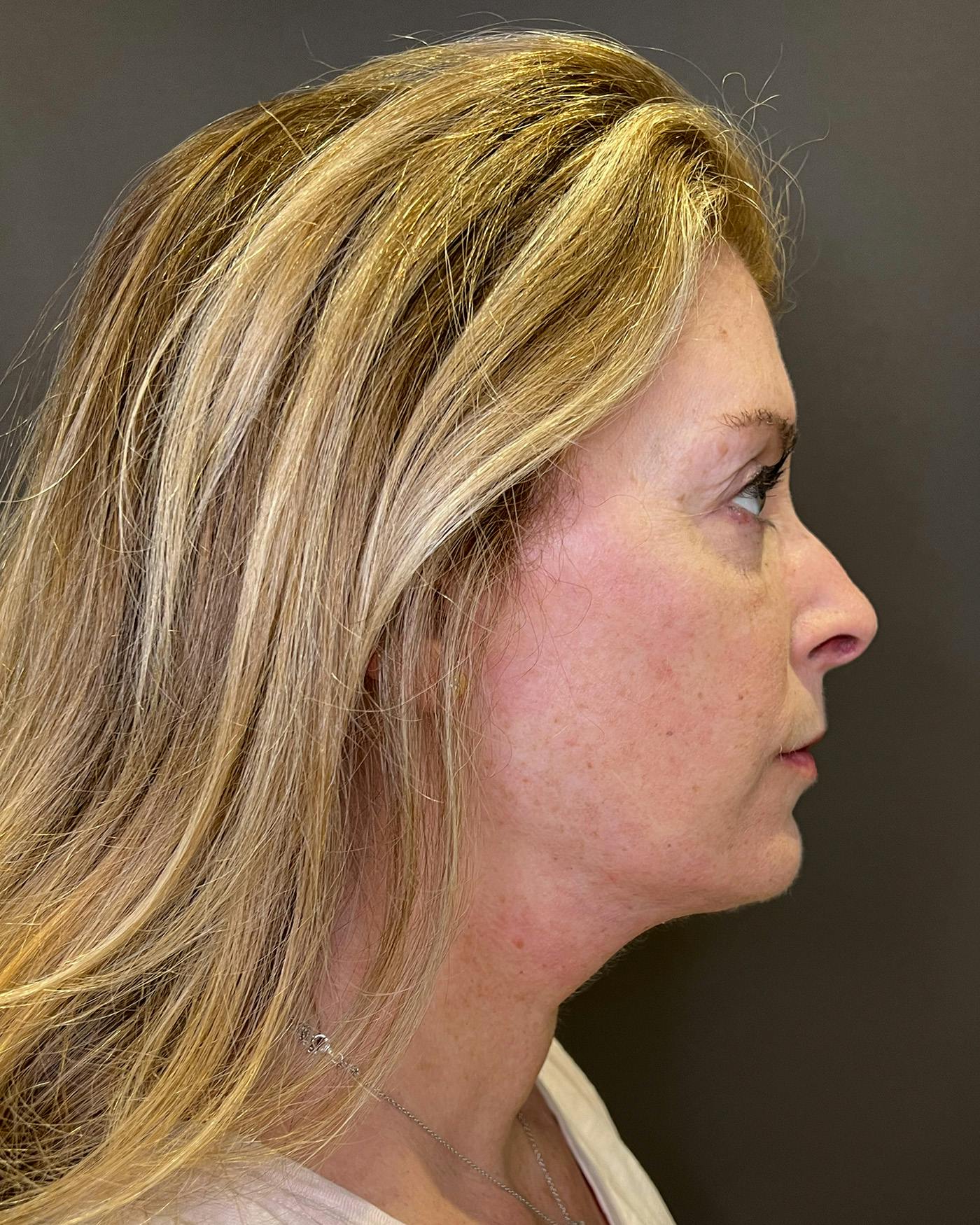 Facelifts / Necklift Before & After Gallery - Patient 830010 - Image 2