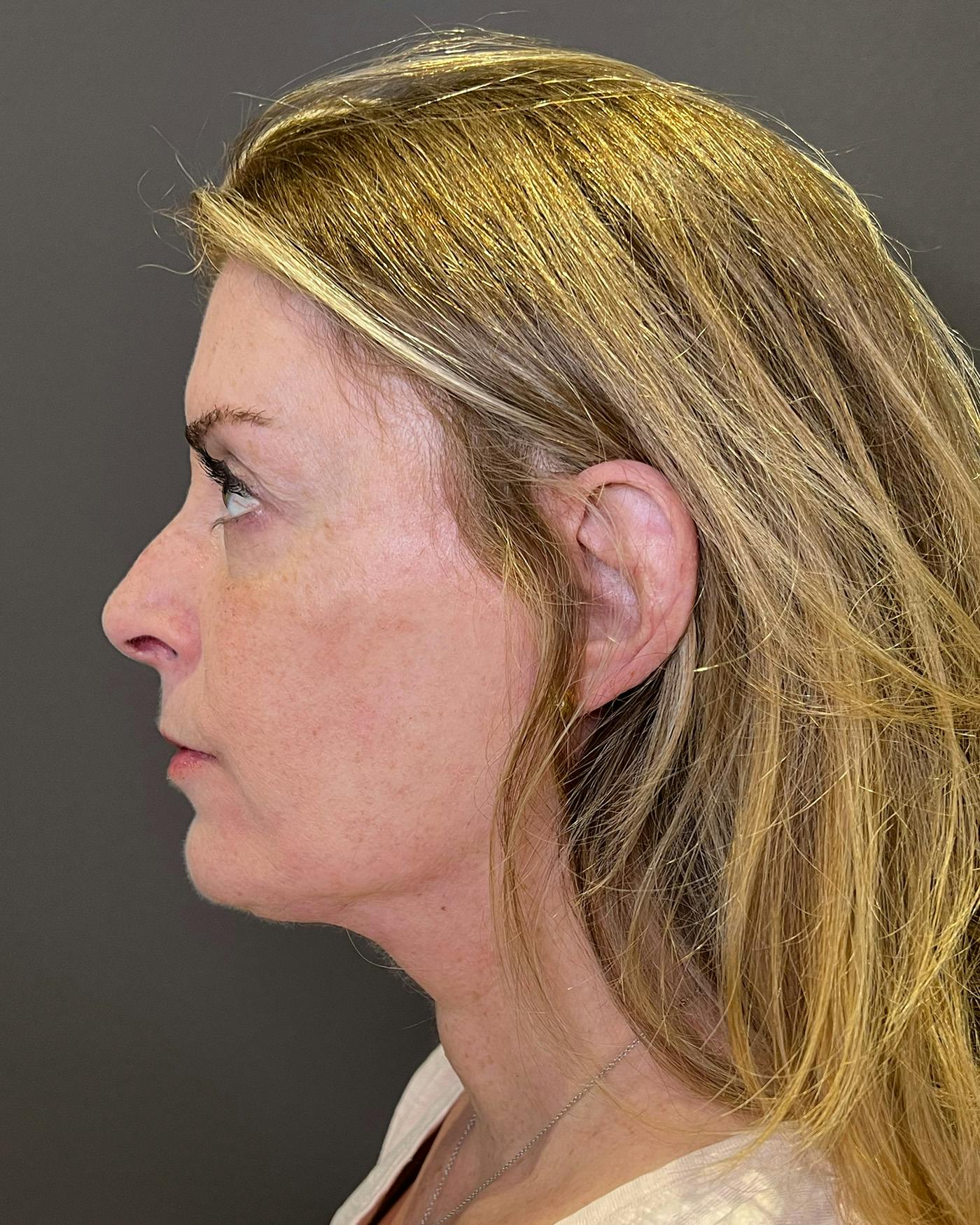 Facelifts / Necklift Before & After Gallery - Patient 830010 - Image 6