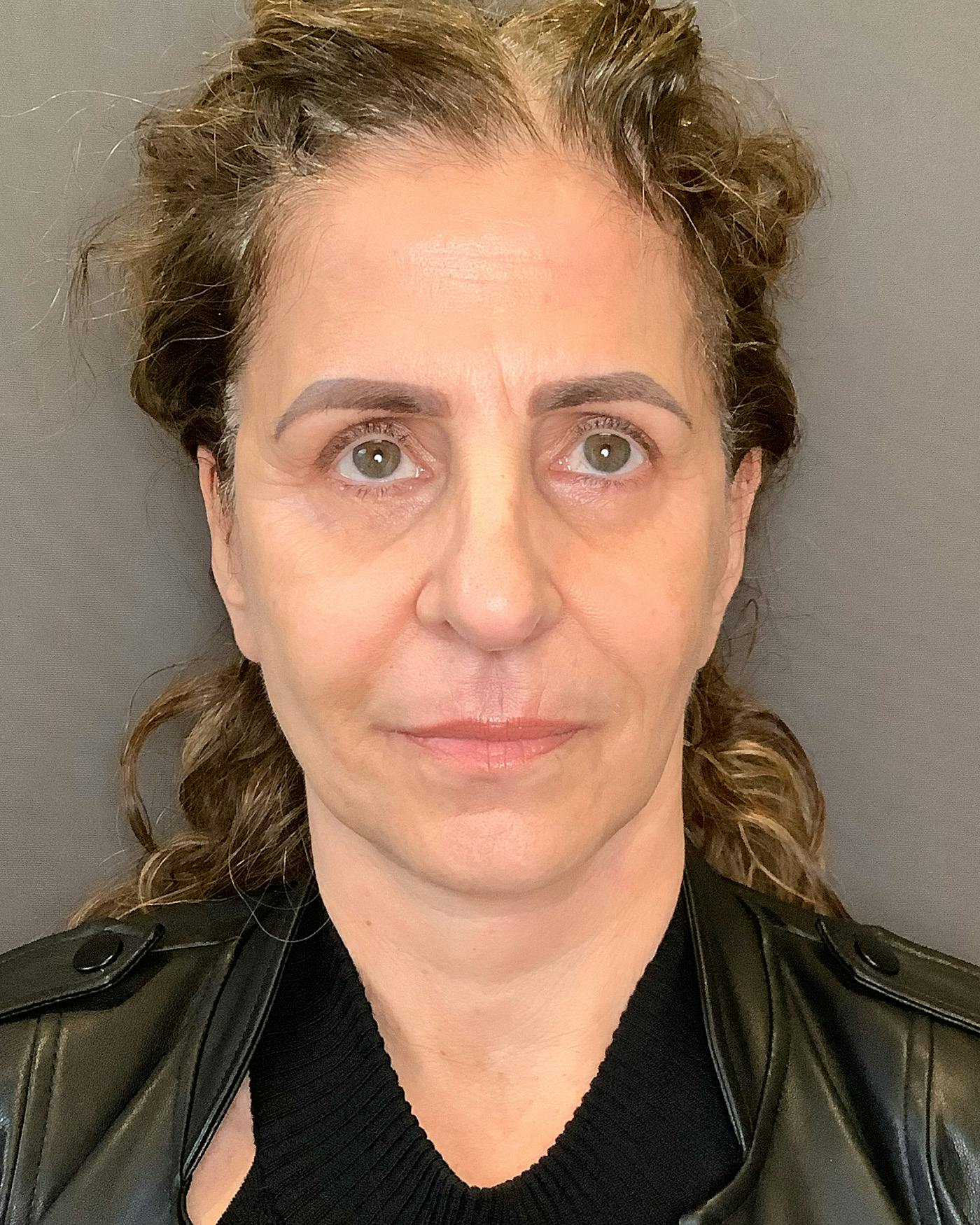 Facelifts / Necklift Before & After Gallery - Patient 208221 - Image 4