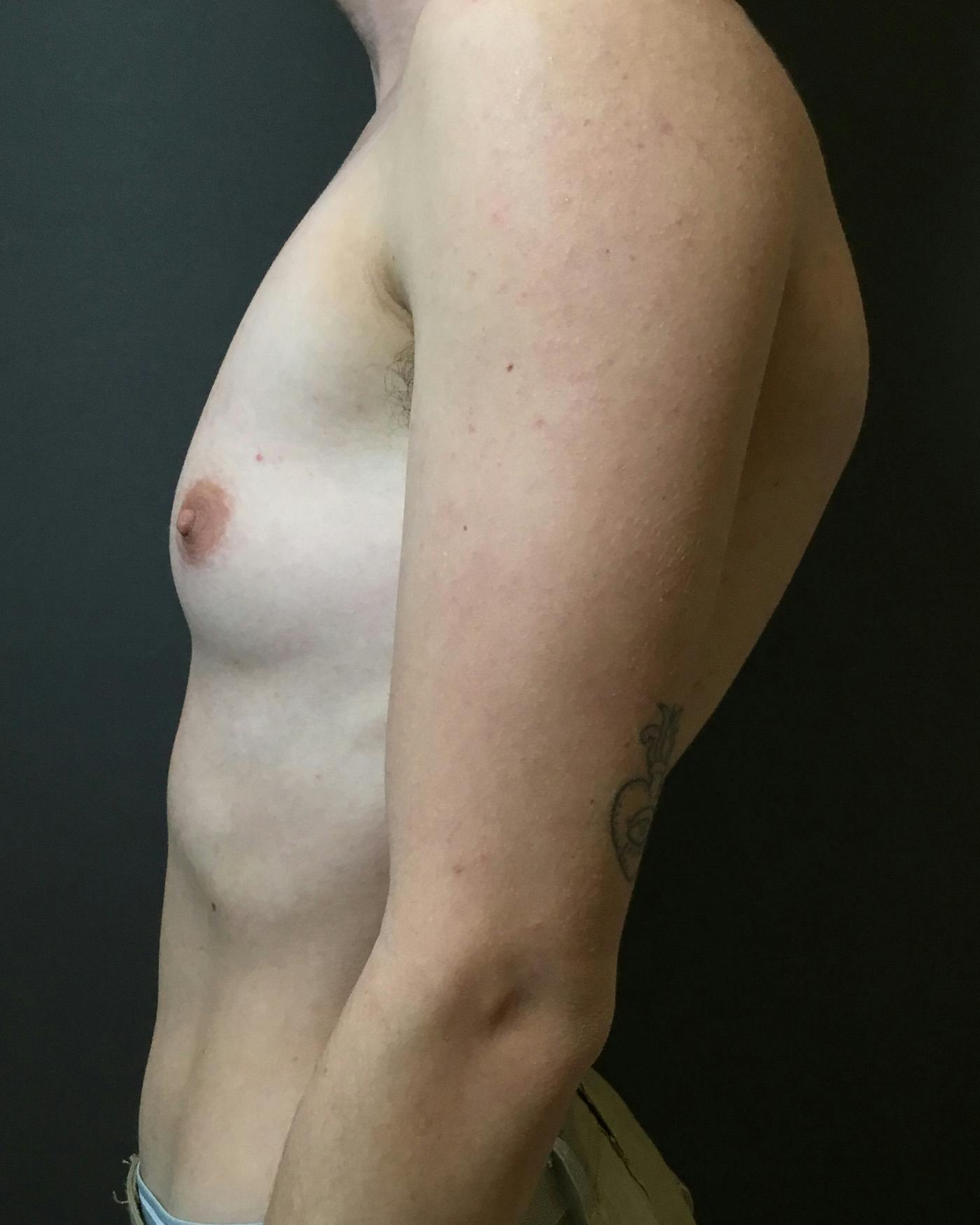 Top Surgery Before & After Gallery - Patient 149616 - Image 5