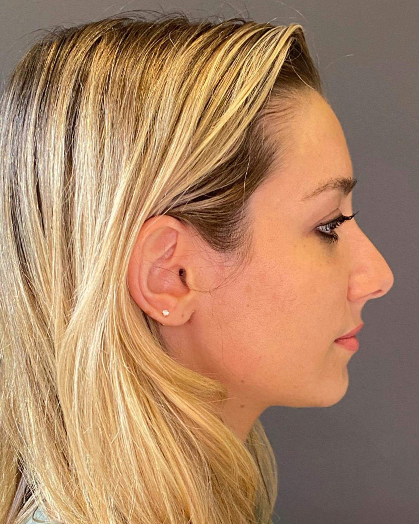 Rhinoplasty Before & After Gallery - Patient 263581 - Image 1