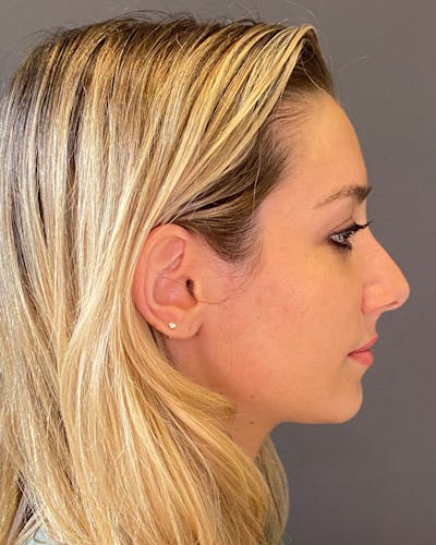 Rhinoplasty Before & After Gallery - Patient 263581 - Image 1