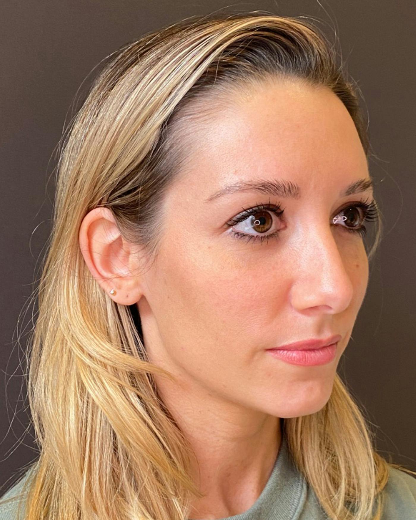 Rhinoplasty Before & After Gallery - Patient 263581 - Image 7