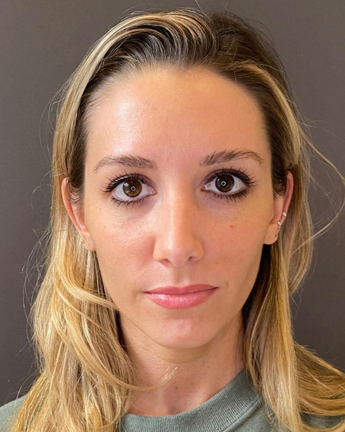 Rhinoplasty Before & After Gallery - Patient 263581 - Image 3