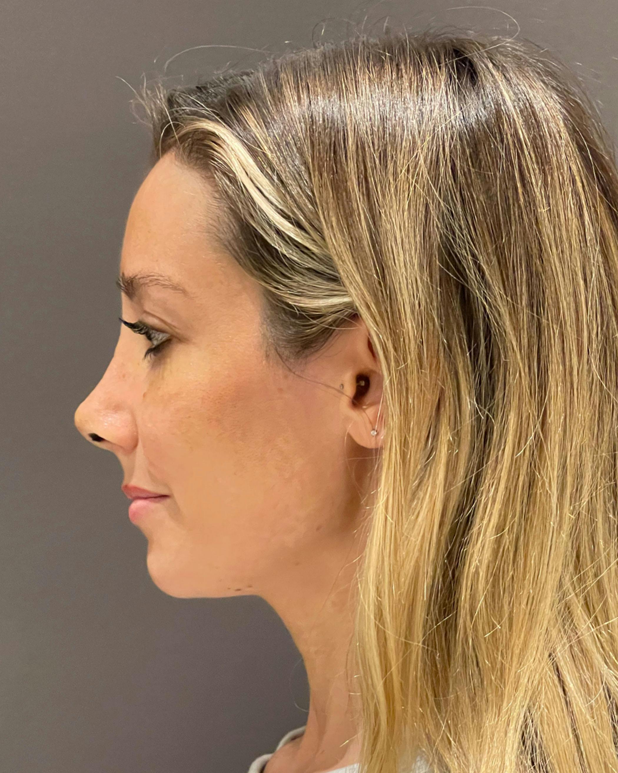 Rhinoplasty Before & After Gallery - Patient 263581 - Image 6