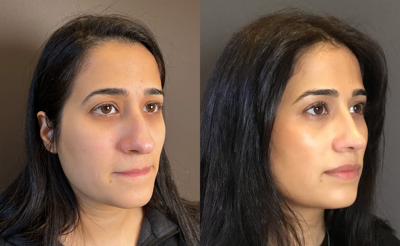 Rhinoplasty Before & After Gallery - Patient 329170 - Image 2