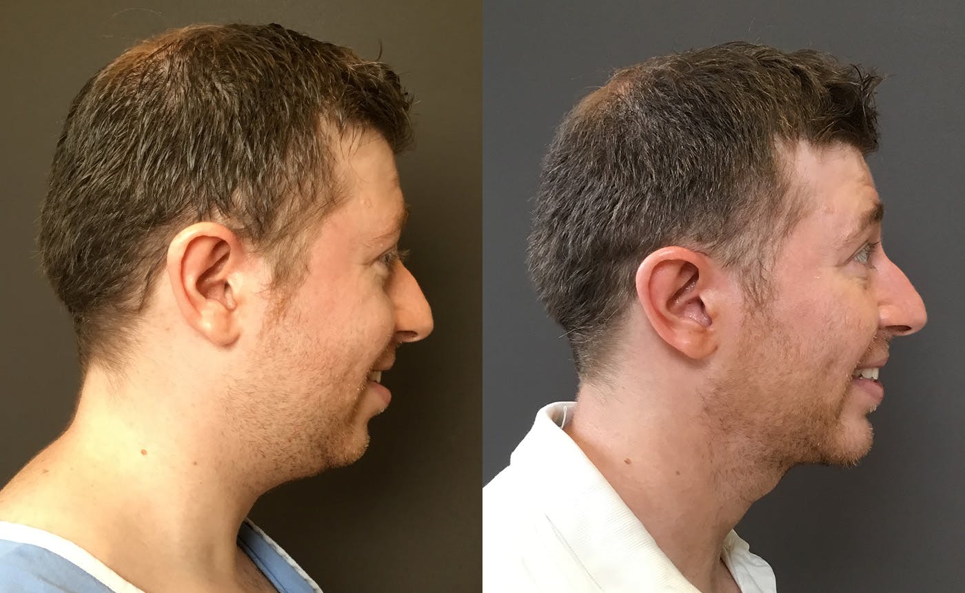 Chin Augmentation Before & After Gallery - Patient 360625 - Image 1
