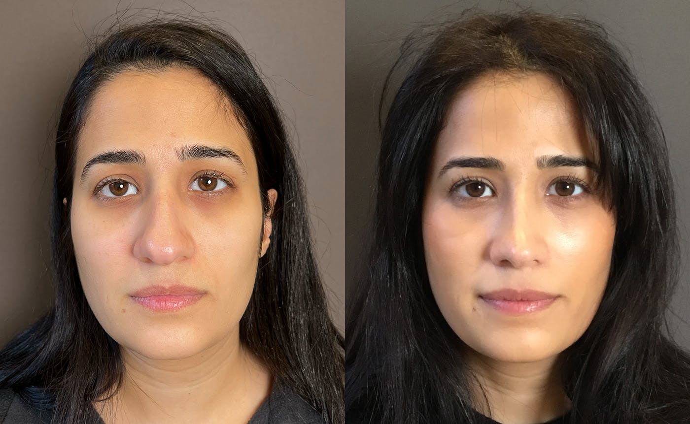 Rhinoplasty Before & After Gallery - Patient 329170 - Image 3