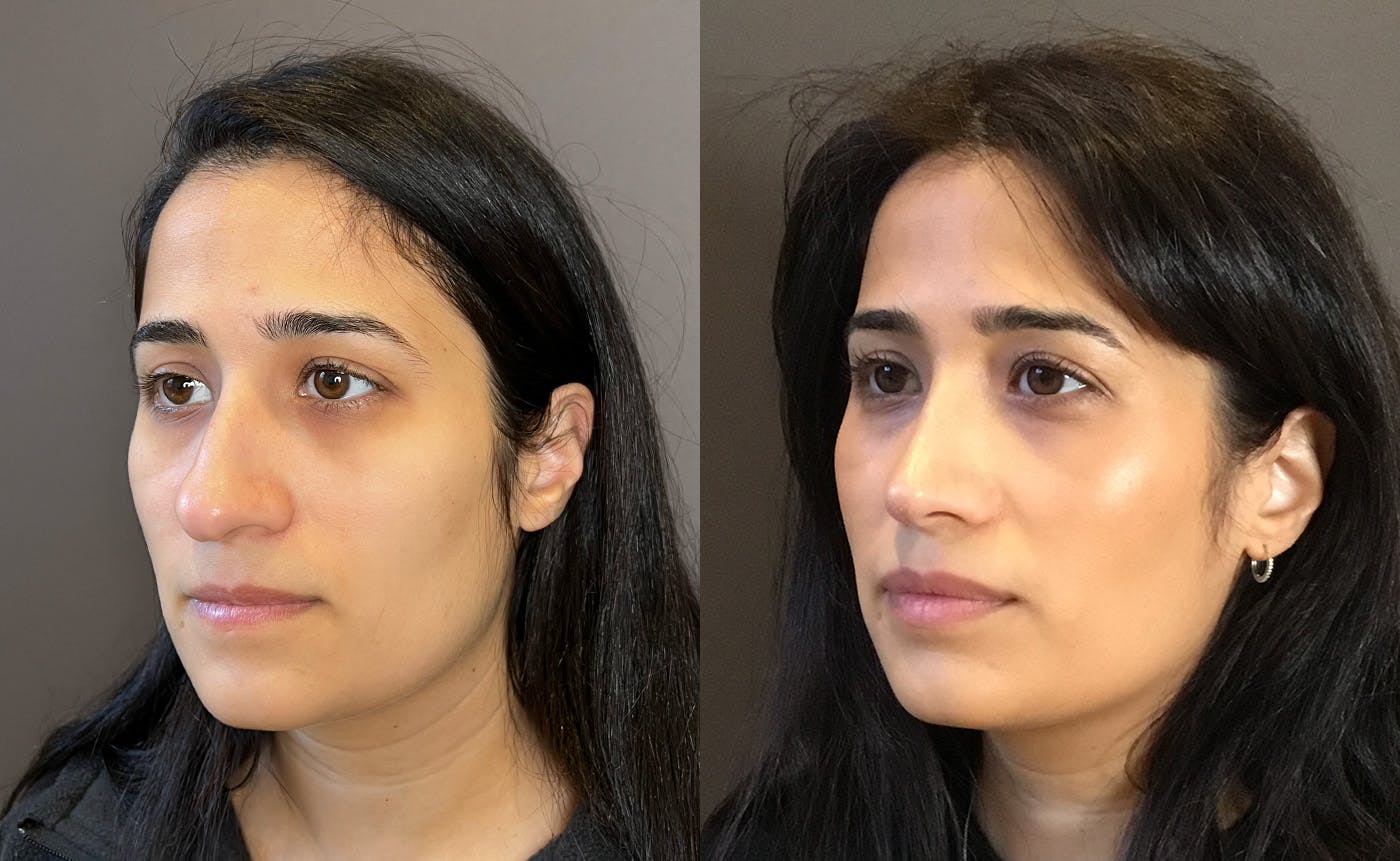 Rhinoplasty Before & After Gallery - Patient 329170 - Image 4