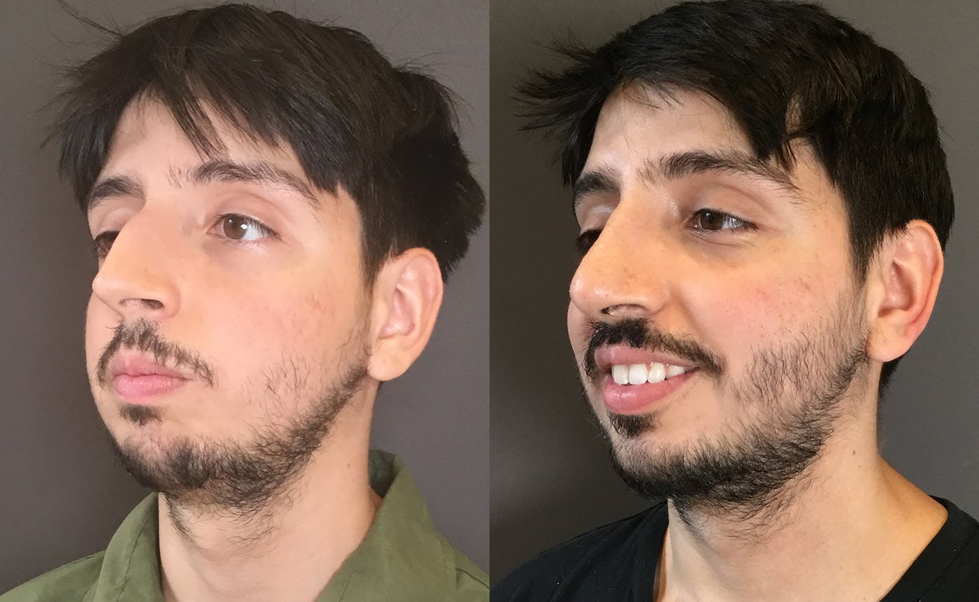 Rhinoplasty Before & After Gallery - Patient 165207 - Image 5