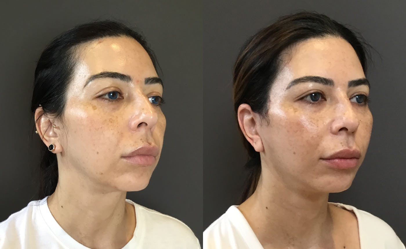 Facelifts / Necklift Before & After Gallery - Patient 304430 - Image 2