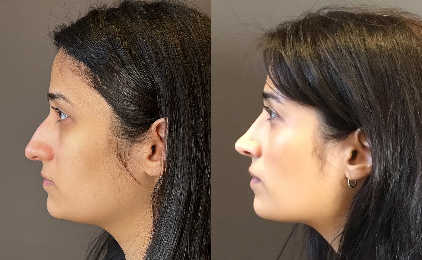 Rhinoplasty Before & After Gallery - Patient 329170 - Image 5