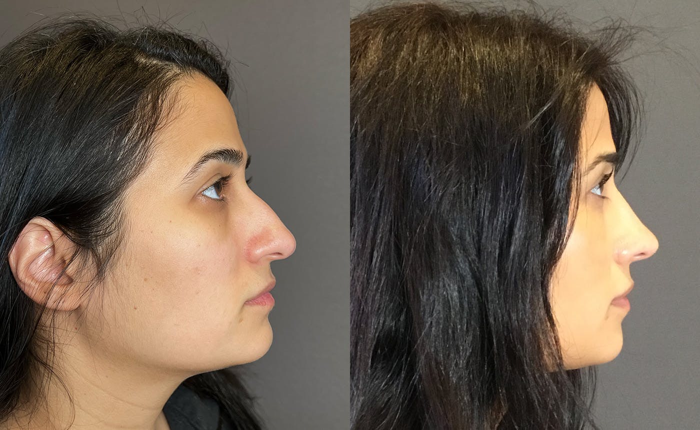 Rhinoplasty Before & After Gallery - Patient 329170 - Image 1
