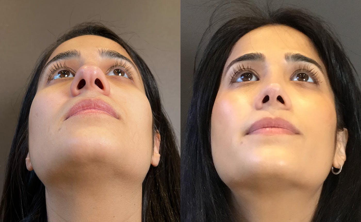 Rhinoplasty Before & After Gallery - Patient 329170 - Image 7