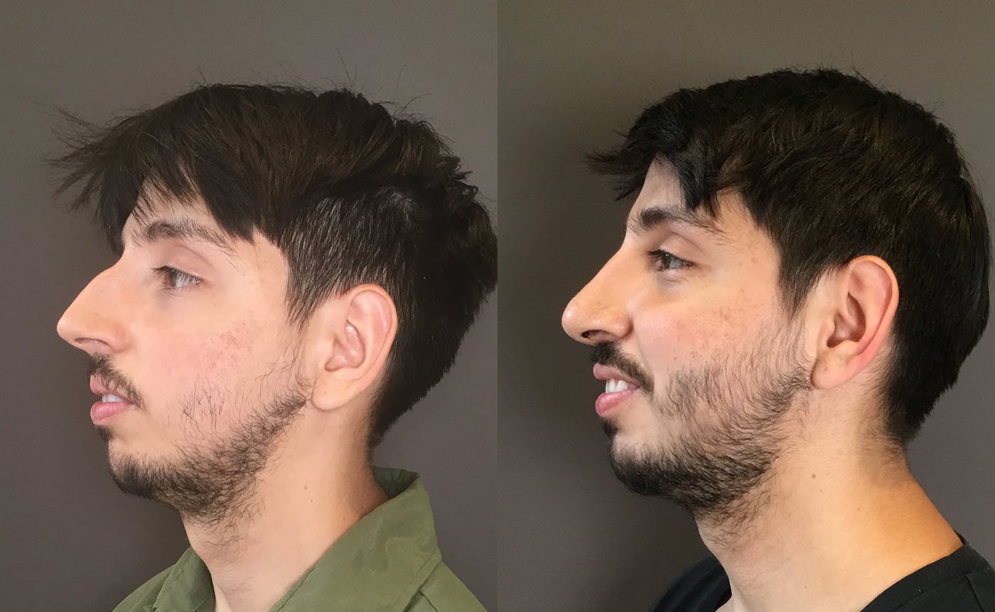 Rhinoplasty Before & After Gallery - Patient 165207 - Image 4
