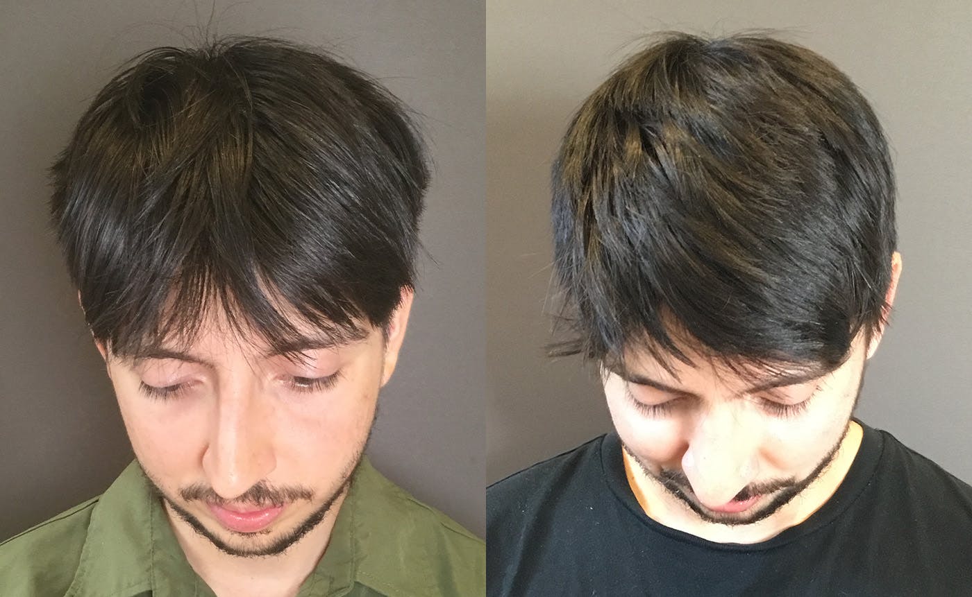 Rhinoplasty Before & After Gallery - Patient 165207 - Image 6