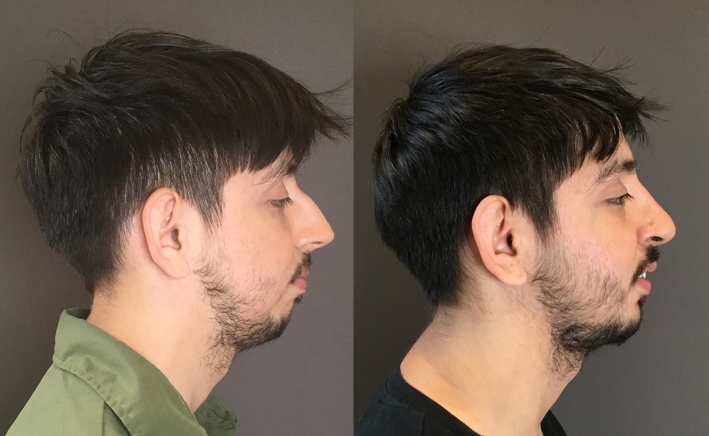Rhinoplasty Before & After Gallery - Patient 165207 - Image 1