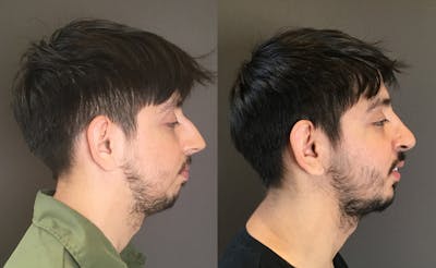 Rhinoplasty Before & After Gallery - Patient 165207 - Image 1