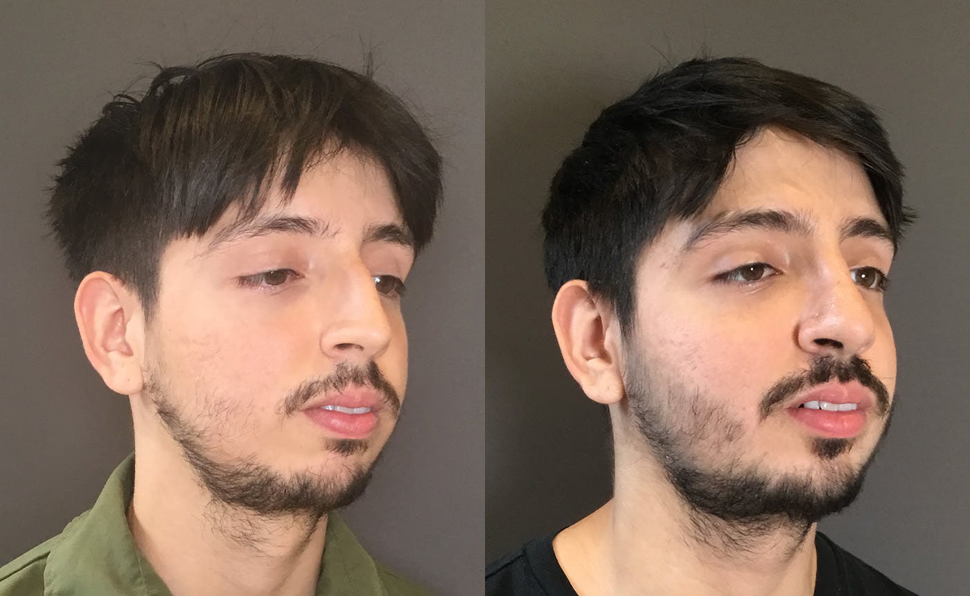 Rhinoplasty Before & After Gallery - Patient 165207 - Image 2