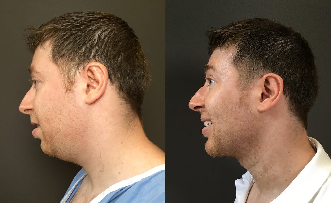 Chin Augmentation Before & After Gallery - Patient 360625 - Image 4