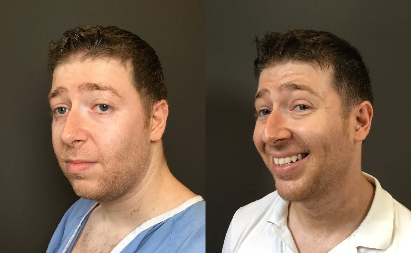 Chin Augmentation Before & After Gallery - Patient 360625 - Image 5