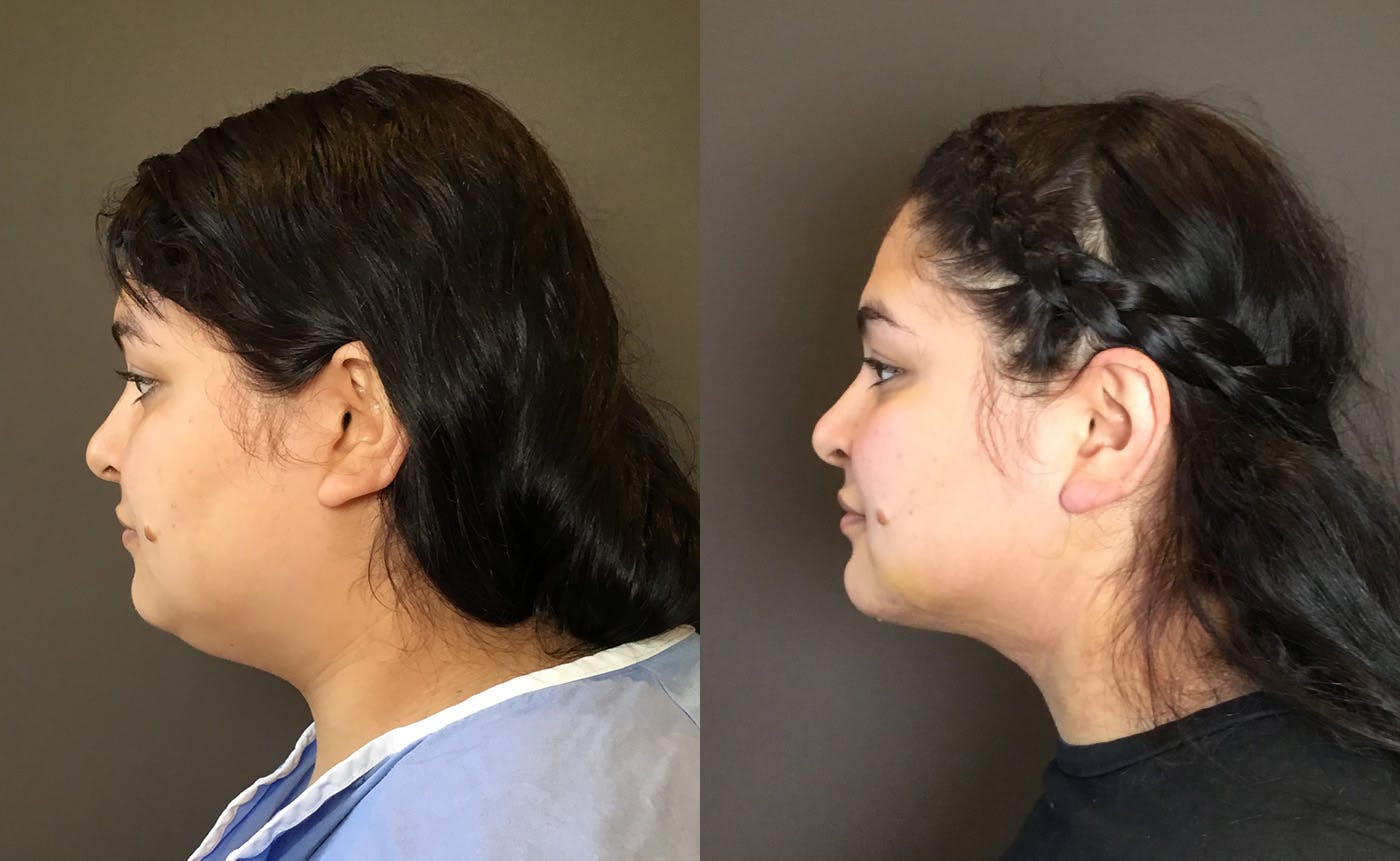 Chin Augmentation Before & After Gallery - Patient 159722 - Image 2