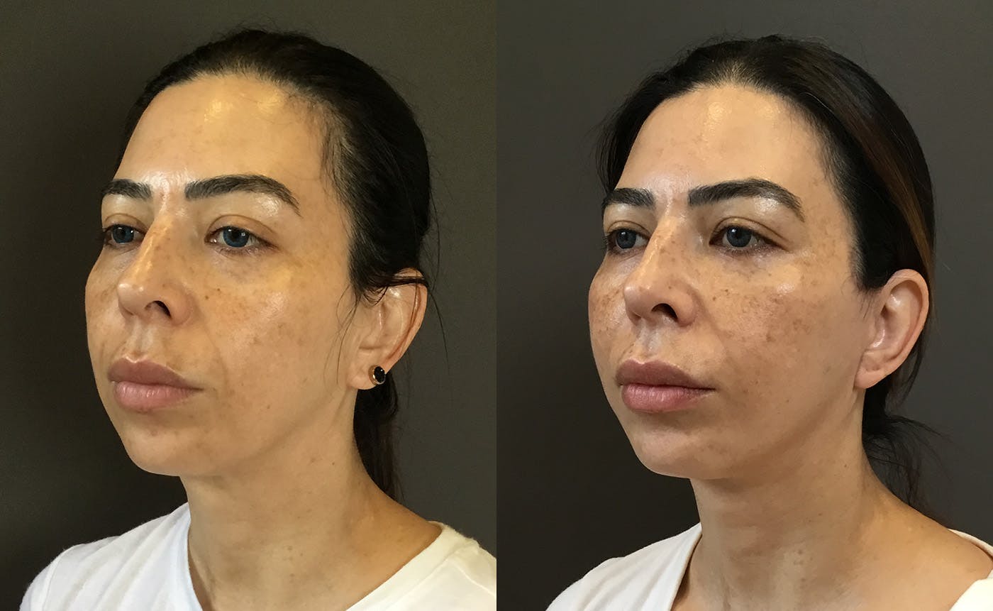 Facelifts / Necklift Before & After Gallery - Patient 304430 - Image 4