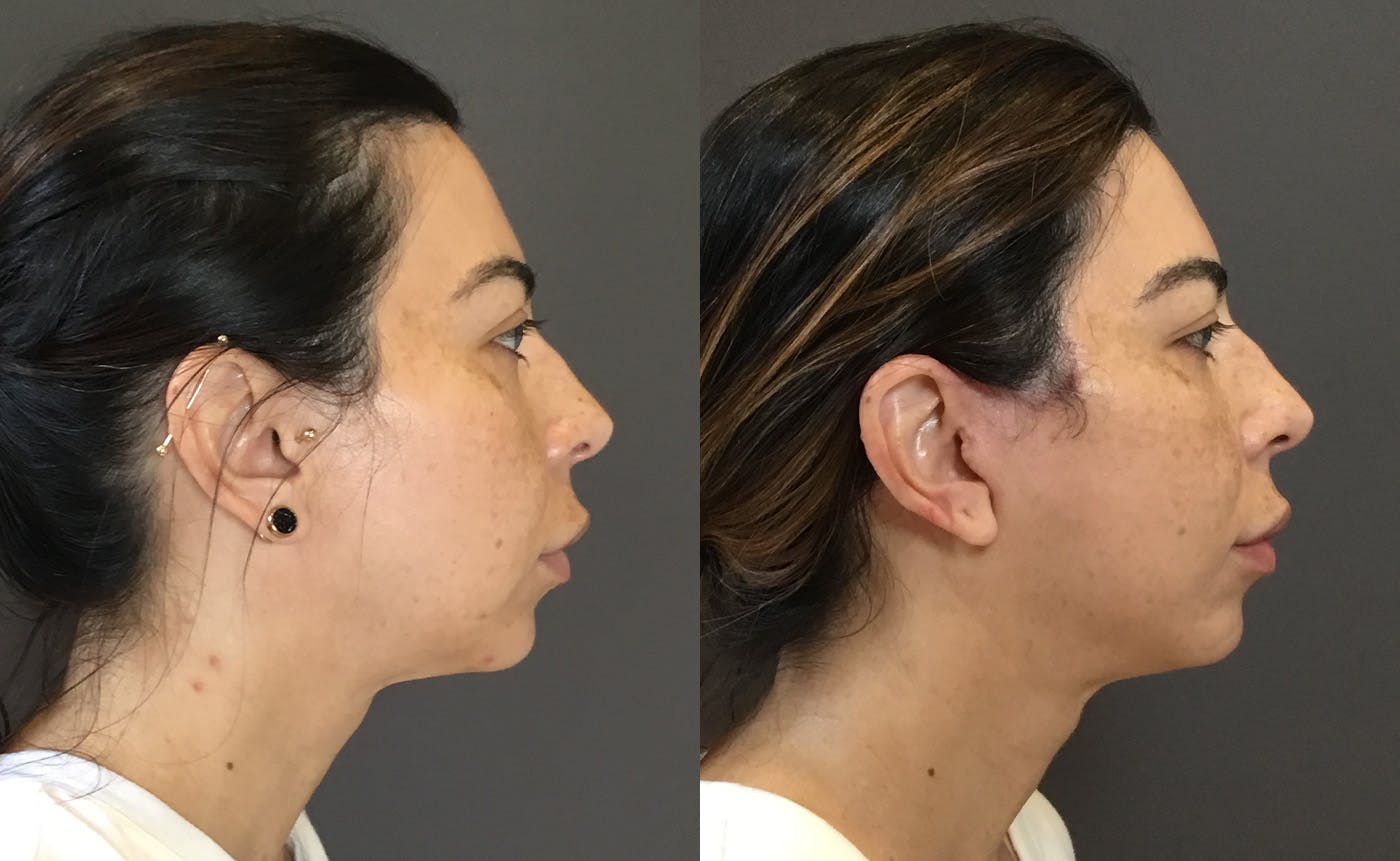 Facelifts / Necklift Before & After Gallery - Patient 304430 - Image 1