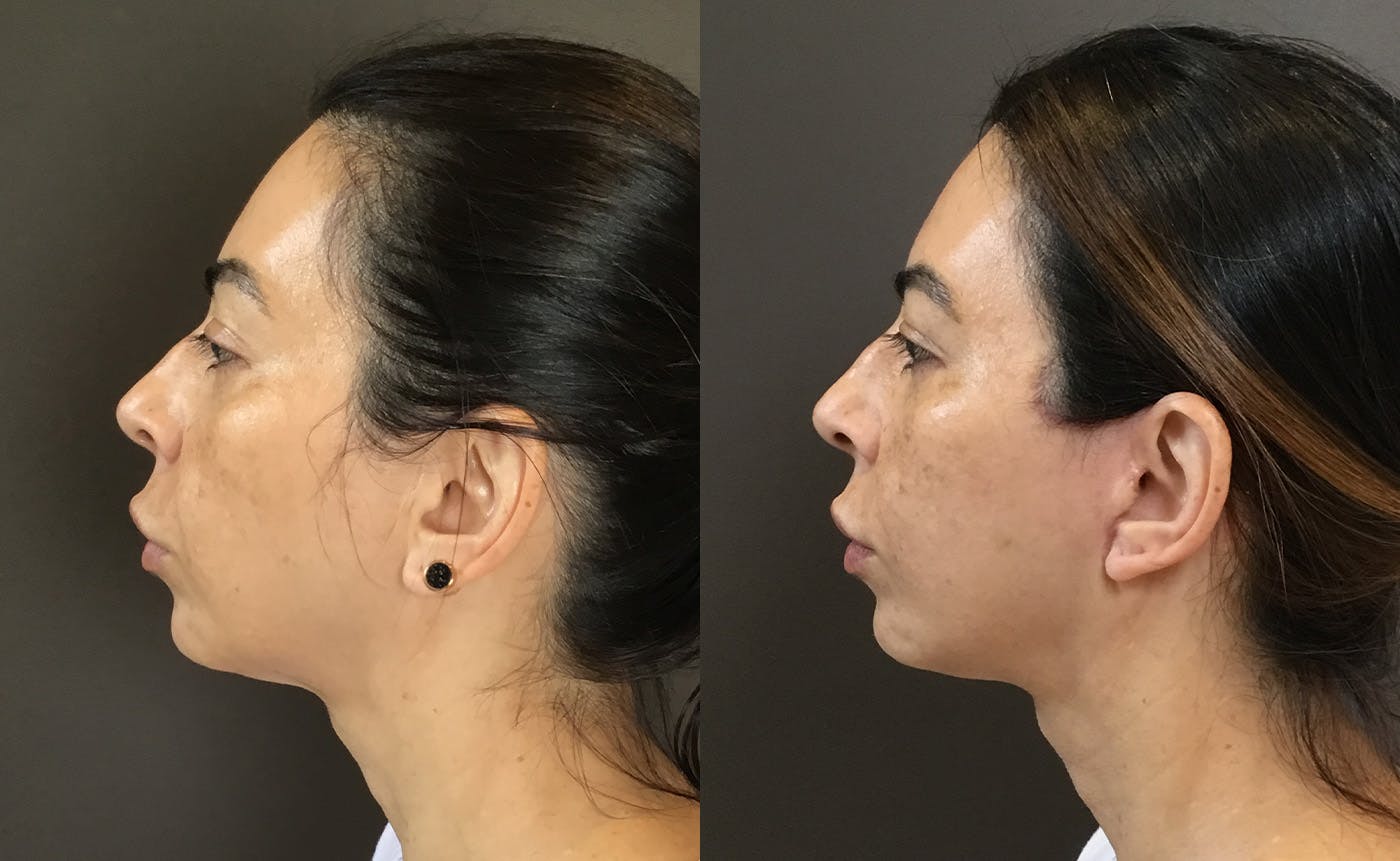 Facelifts / Necklift Before & After Gallery - Patient 304430 - Image 3
