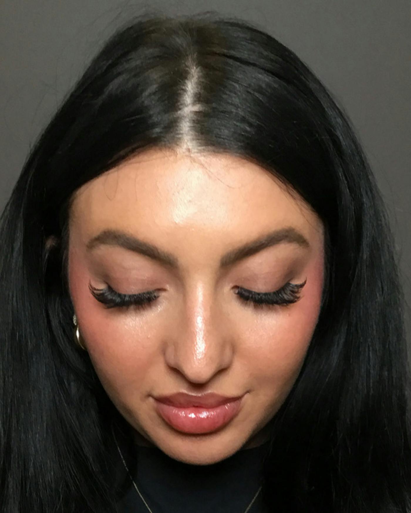 Rhinoplasty Before & After Gallery - Patient 390758 - Image 9