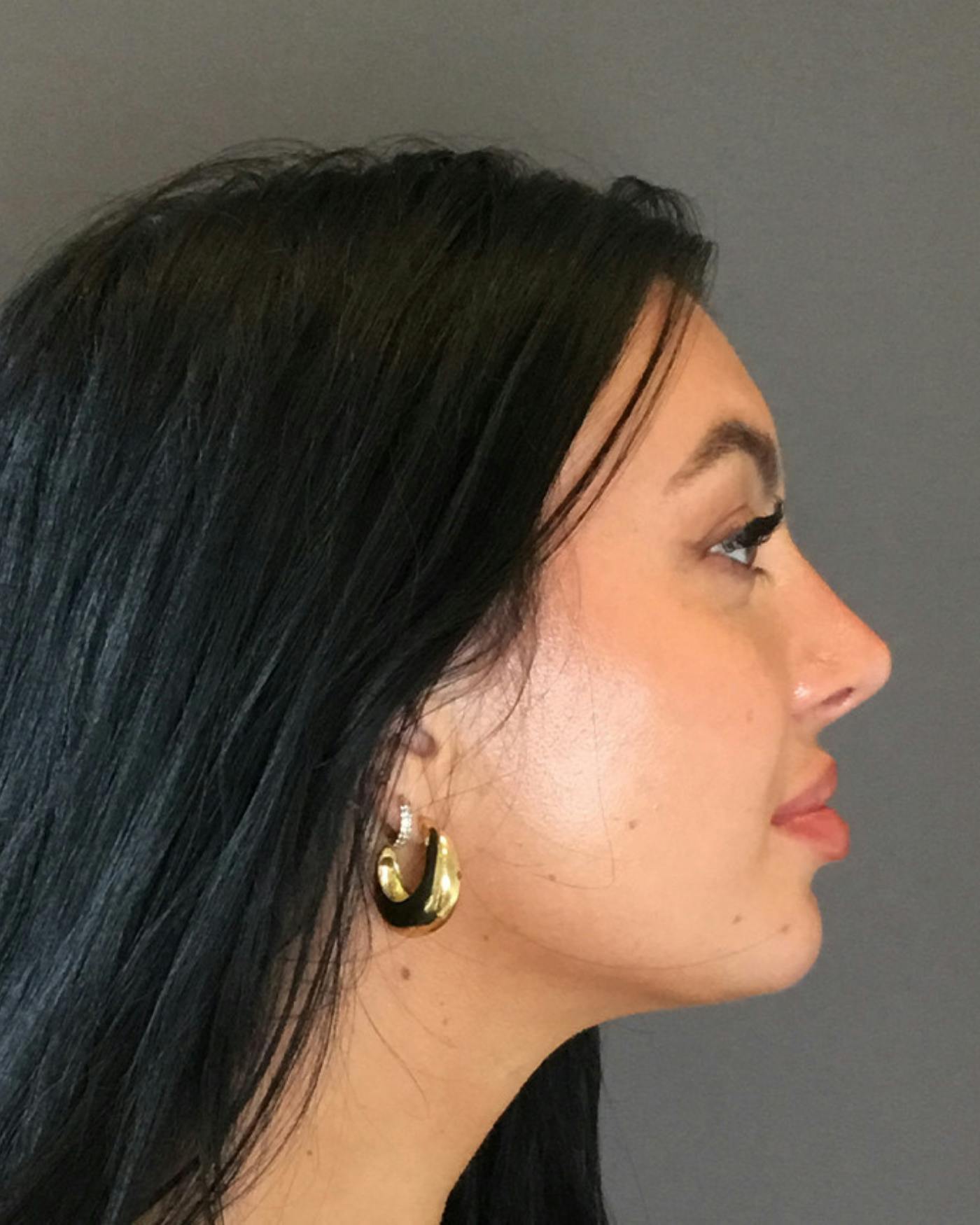 Rhinoplasty Before & After Gallery - Patient 390758 - Image 2