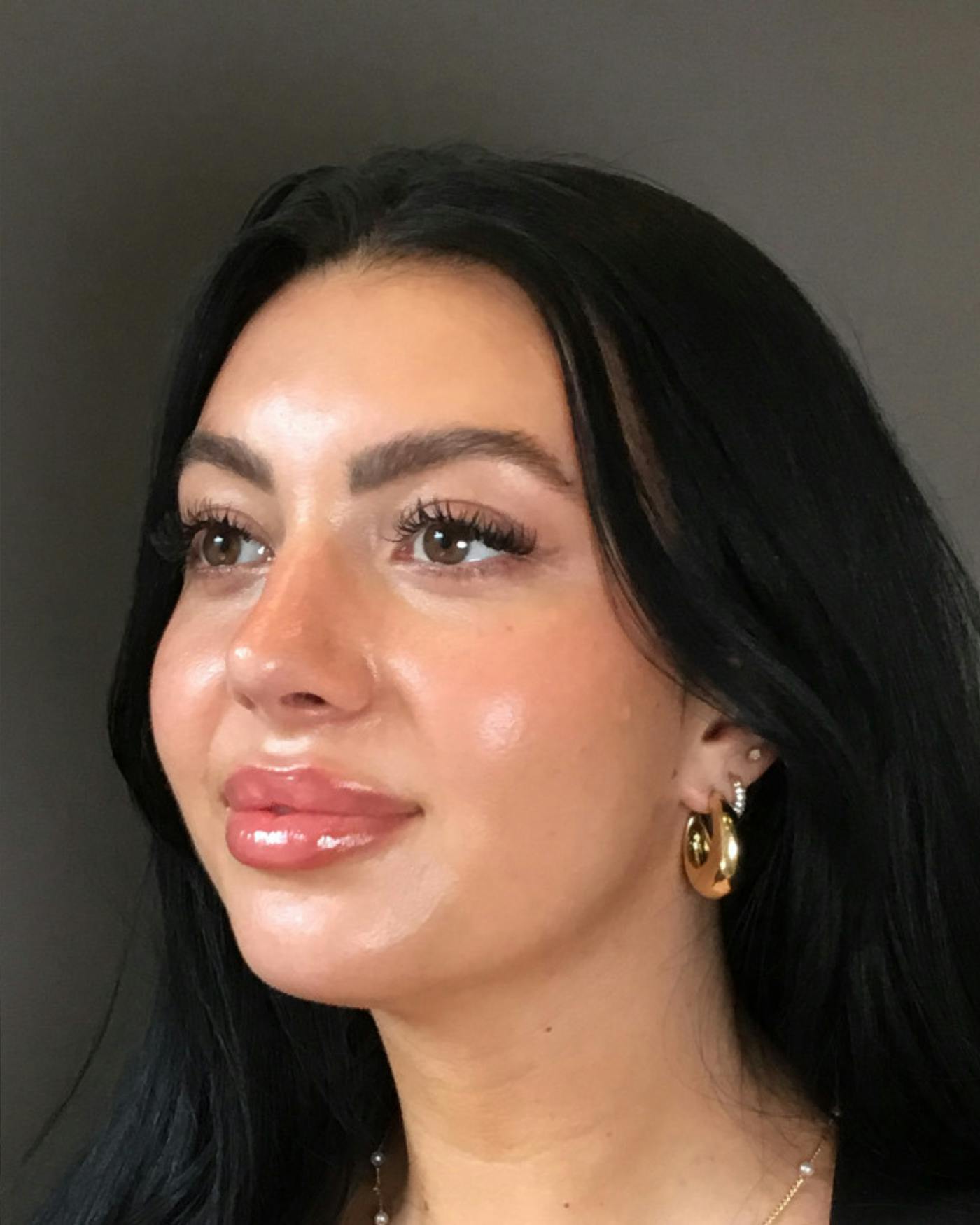 Rhinoplasty Before & After Gallery - Patient 390758 - Image 8