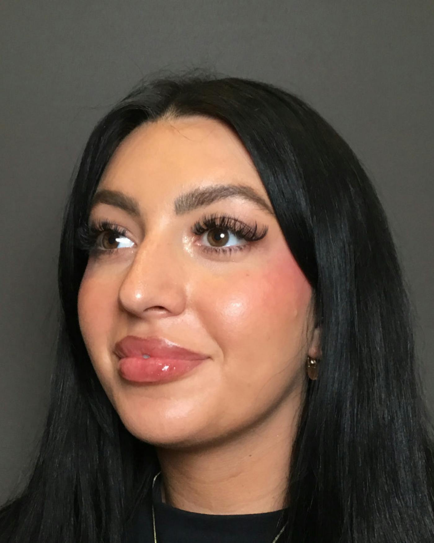 Rhinoplasty Before & After Gallery - Patient 390758 - Image 7