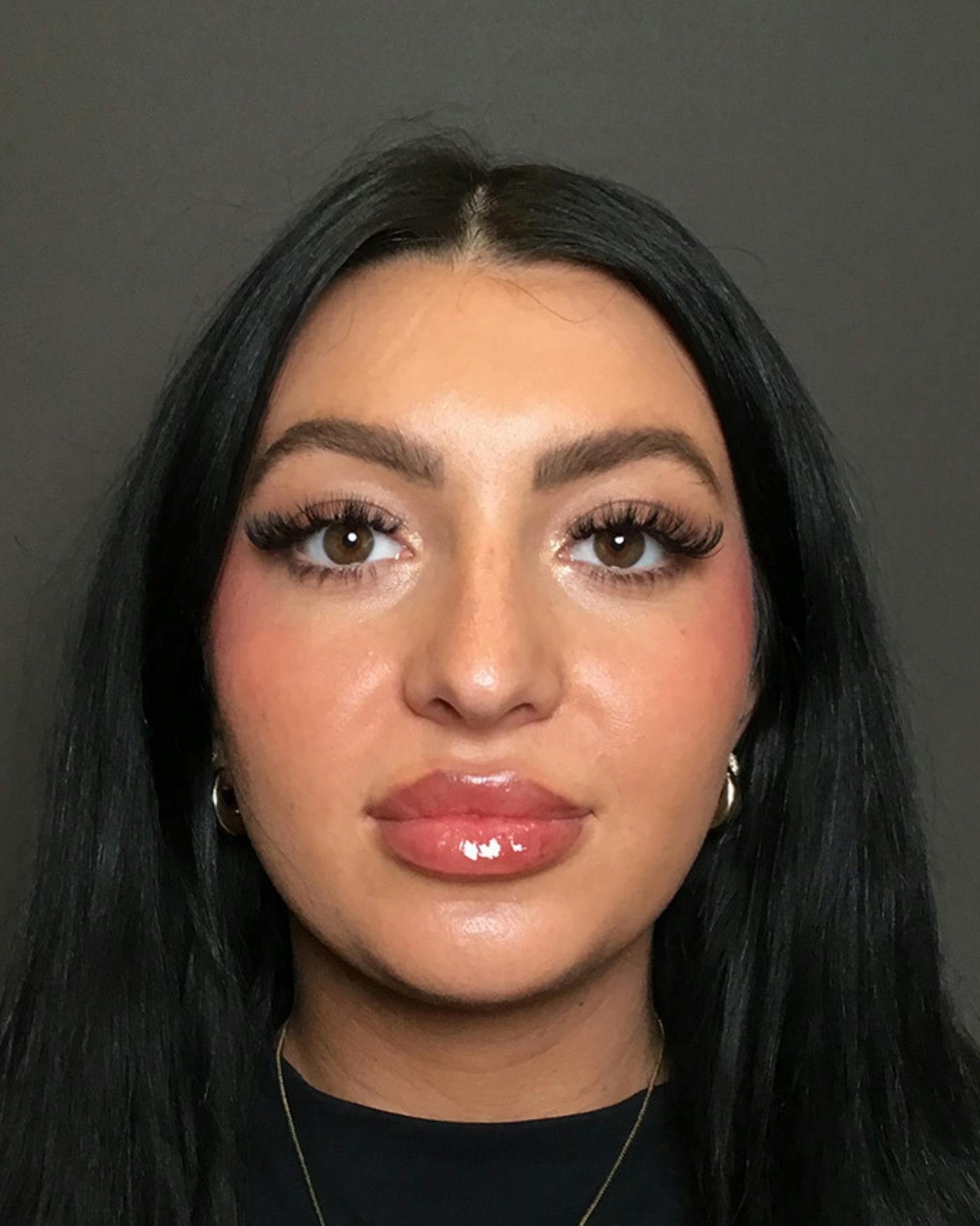 Rhinoplasty Before & After Gallery - Patient 390758 - Image 5