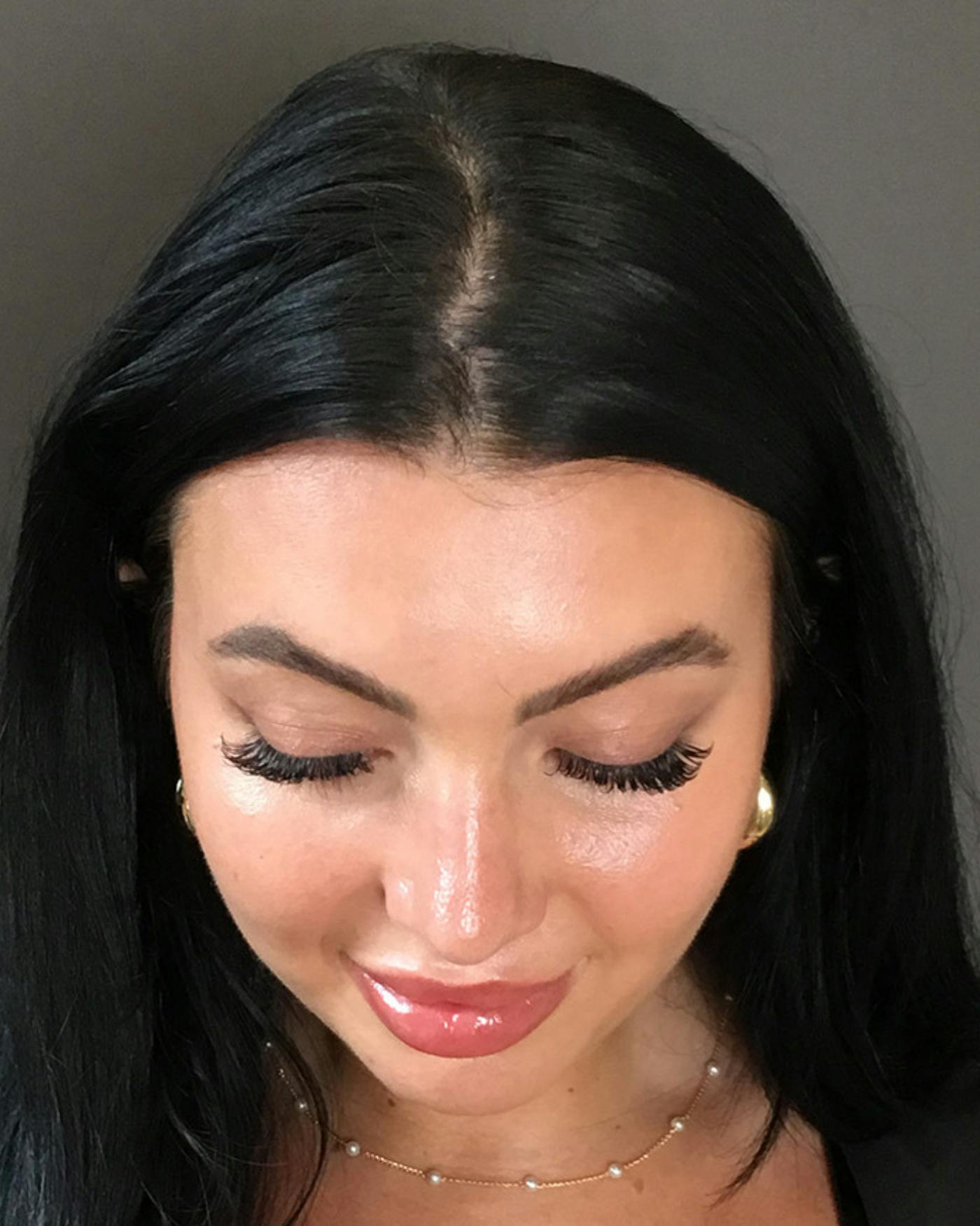 Rhinoplasty Before & After Gallery - Patient 390758 - Image 10