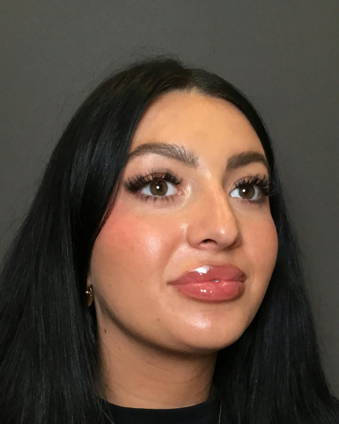 Rhinoplasty Before & After Gallery - Patient 390758 - Image 3